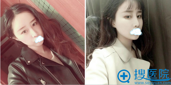 经过王文革院长修复的美鼻 经过王文革院长修复的美鼻