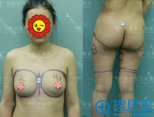 玉之光王明利博士设计的吸脂和隆胸手术方案
