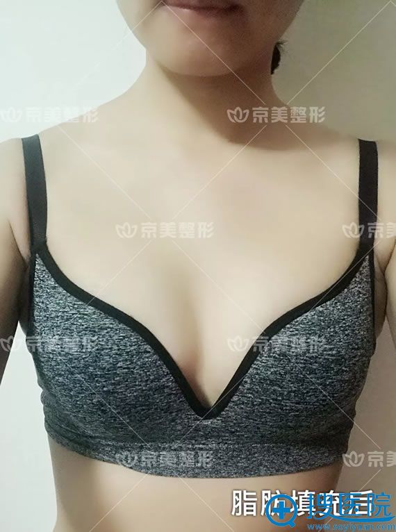 北京京美自体脂肪隆胸案例2周效果