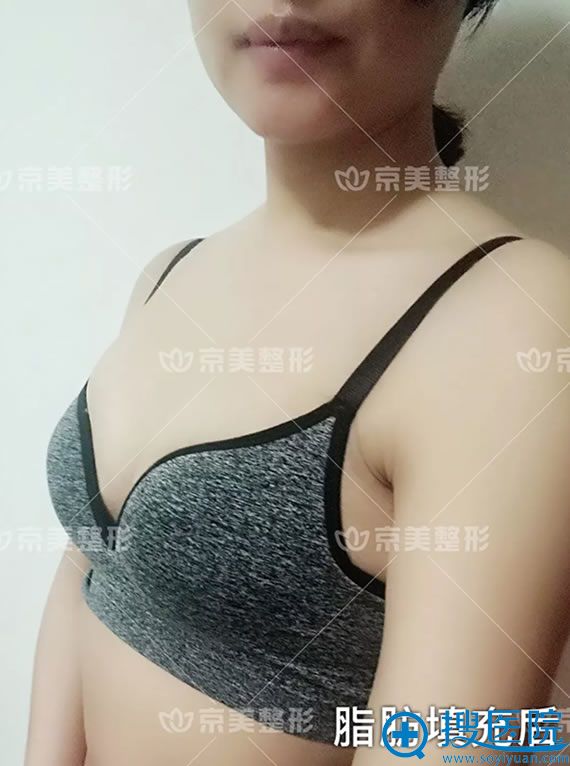 京美刘成胜假体取出做脂肪丰胸案例