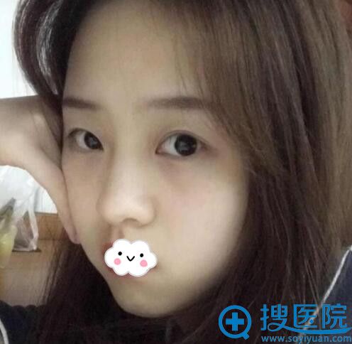 到金华心艺整形做双眼皮术前 到金华心艺整形做双眼皮术前