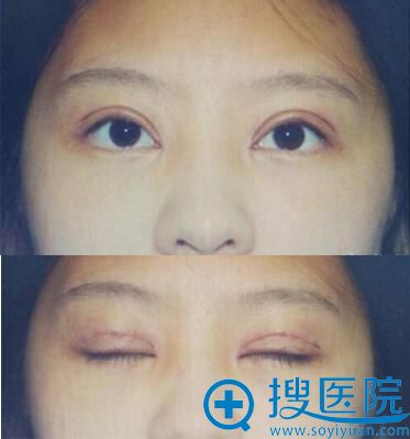 金华心艺双眼皮术后7天与闭眼效果 金华心艺双眼皮术后7天与闭眼效果
