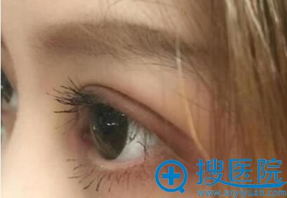 金华心艺整形双眼皮术后20天案例 金华心艺整形双眼皮术后20天案例