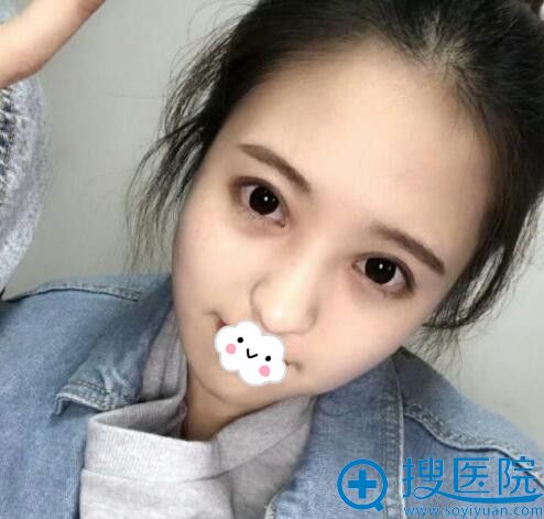 金华心艺黄盛高双眼皮案例术后1个月效果 金华心艺黄盛高双眼皮案例术后1个月效果