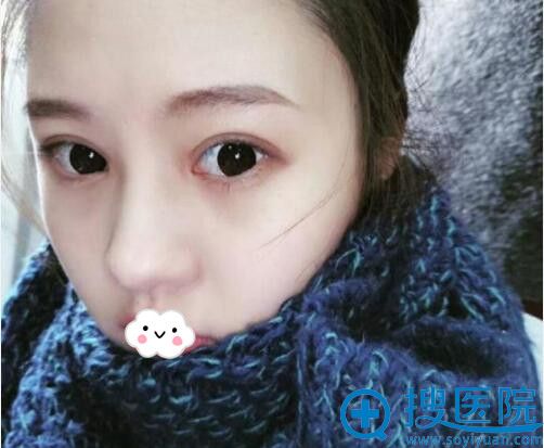 金华心艺黄盛高双眼皮案例术后50天 金华心艺黄盛高双眼皮案例术后50天