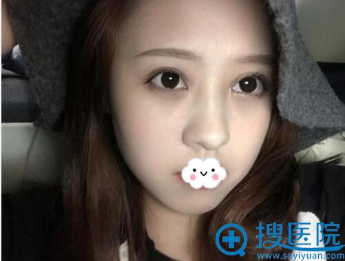 金华心艺整形医院双眼皮案例术后60天 金华心艺整形医院双眼皮案例术后60天