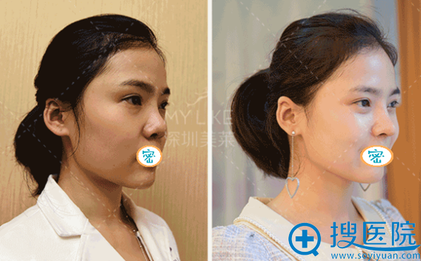 深圳美莱梁晓健达拉斯隆鼻术后对比照