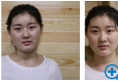 面诊了济南历下美莱韩旭和汪峰后选择韩旭做了动感无痕双眼皮