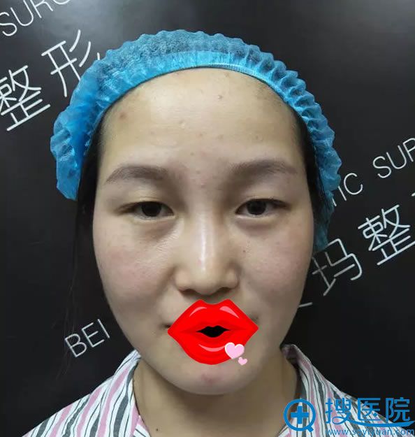 埋线双眼皮脱落后的照片 埋线双眼皮脱落后的照片