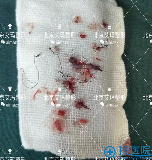 取出埋线双眼皮断裂的线 取出埋线双眼皮断裂的线