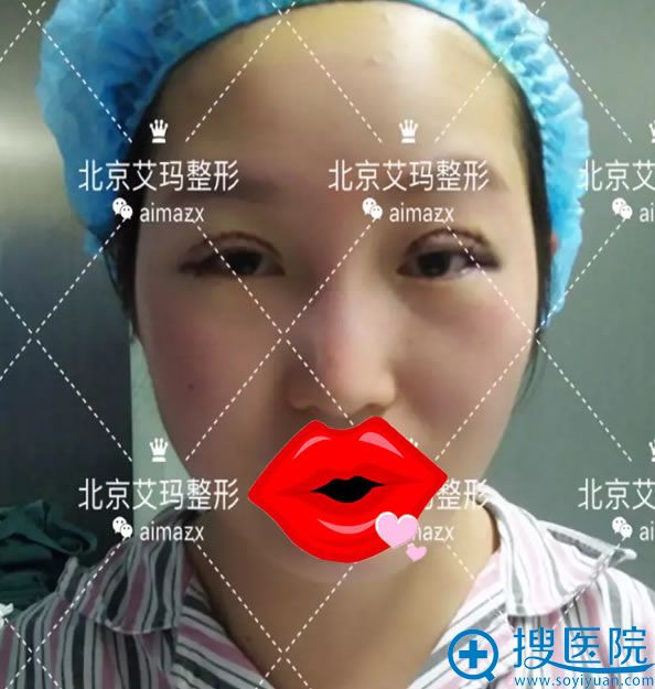 埋线取出修复全切双眼皮即刻效果 埋线取出修复全切双眼皮即刻效果