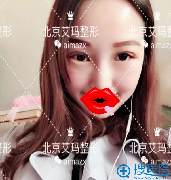 在艾玛做双眼皮手术5天恢复照 在艾玛做双眼皮手术5天恢复照