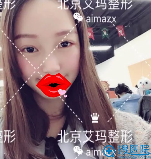 做完双眼皮和开外眼角恢复效果 做完双眼皮和开外眼角恢复效果