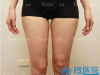 西安艺星大腿吸脂解决局部肥胖 脂肪提纯后填充面部不做黄脸婆