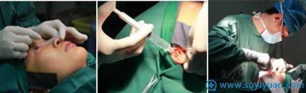 耳软骨垫鼻尖和假体隆鼻手术过程
