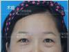 郑州东方员工亲测做完祛眼袋+双眼皮后效果看案例简直相差20岁