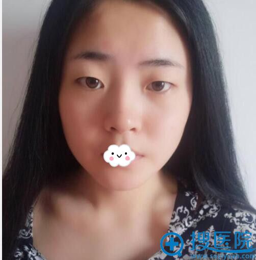 到西安施尔绮做埋线双眼皮前