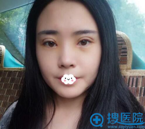西安施尔绮王驰埋线双眼皮术后5天效果