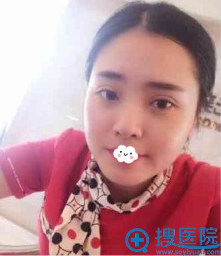 西安施尔绮医学美医疗美容医院埋线双眼皮术后效果