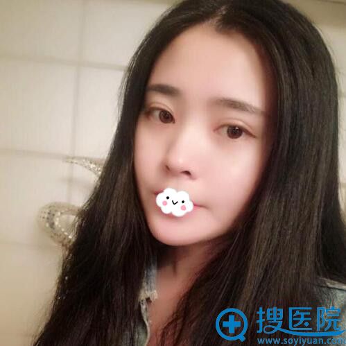 西安施尔绮王驰埋线双眼皮真人案例