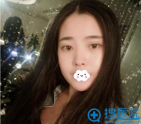 西安施尔绮医学美医疗美容医院埋线双眼皮案例