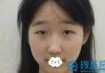 原来沈阳蓝天于国艳给我做的双眼皮没失败？竟然开启美丽后半生