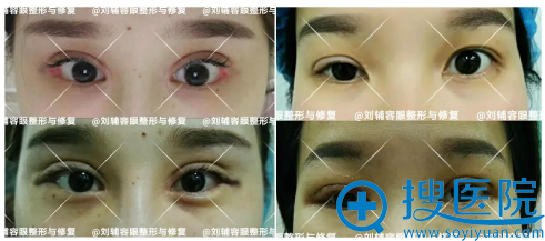 刘辅蓉双眼皮案例