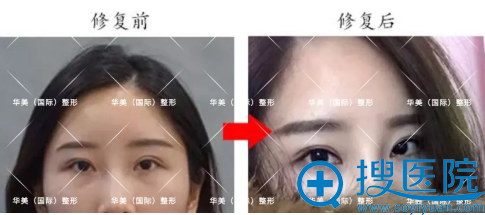 郑东风双眼皮失败修复案例整