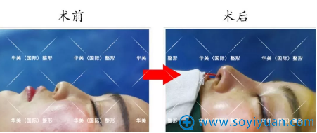 沈正宇埃菲尔半肋综合隆鼻案例