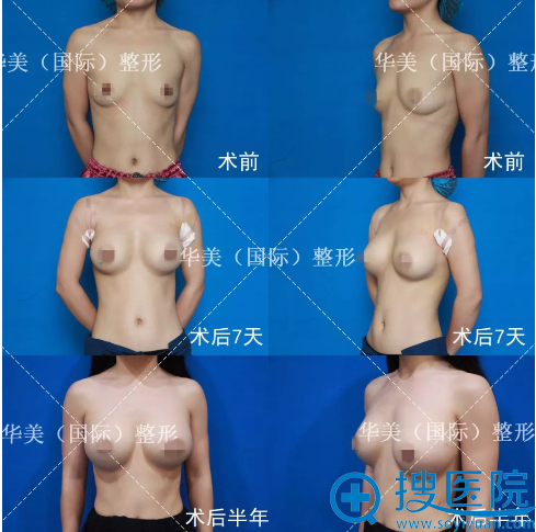 高学龙赫拉魔力沟丰胸案例