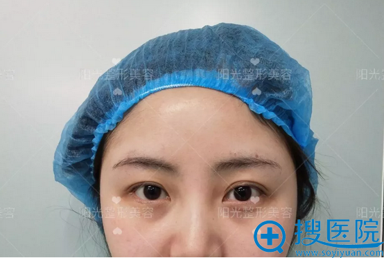 郑州阳光整形美容双眼皮术前