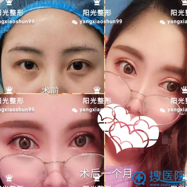 郑州阳光杨小顺双眼皮真人案例