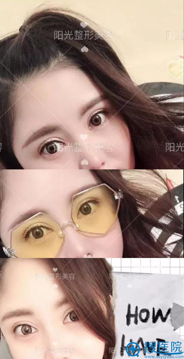郑州阳光杨小顺双眼皮术后效果