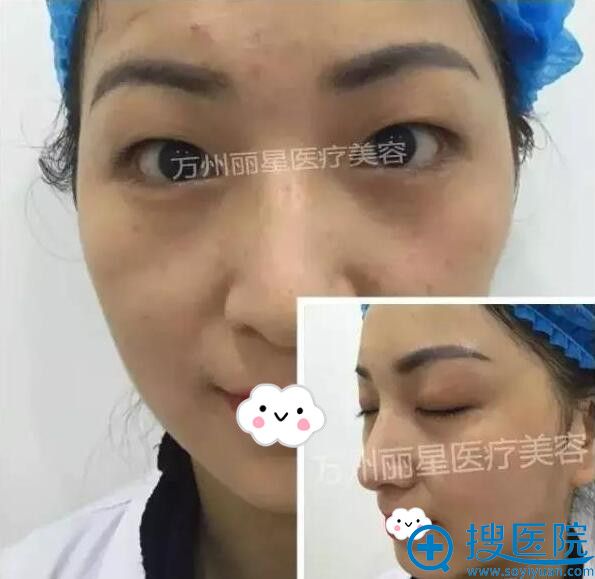 重庆万州丽星整形美容医院双眼皮术前