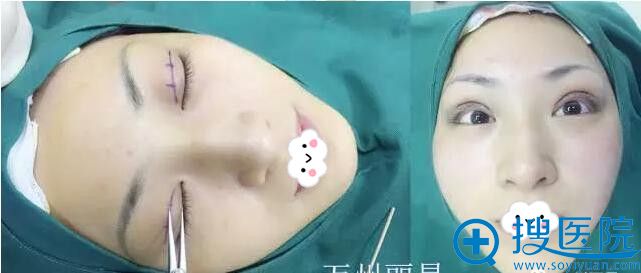 重庆万州丽星双眼皮术后即刻真实效果