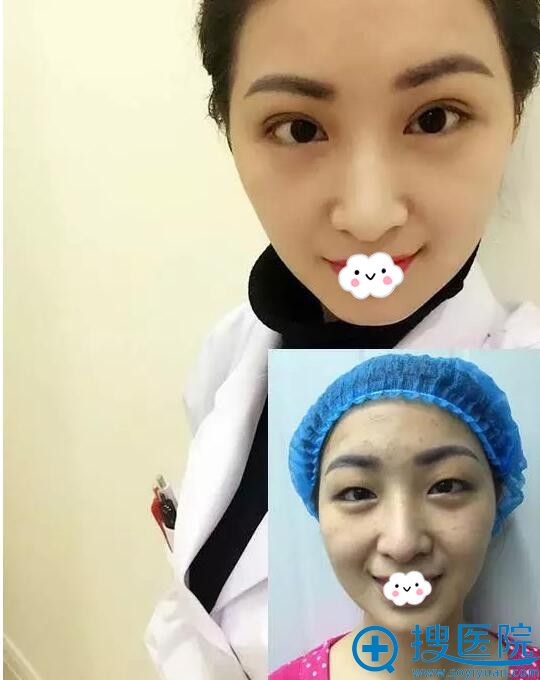 重庆万州丽星双眼皮术后3天