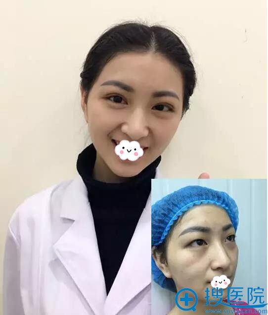重庆万州丽星整形美容医院真人双眼皮案例