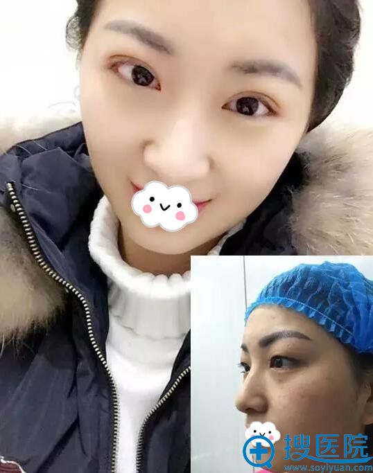 重庆万州丽星双眼皮术后恢复效果