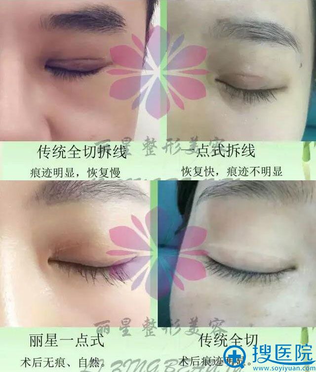 一点式双眼皮与全切双眼皮闭眼对比效果