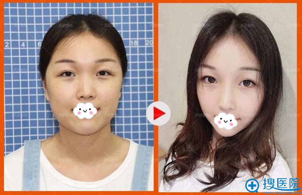 <!--<i data=20240710 data-id=12037></i>-->玻尿酸塑形真人案例前后对比