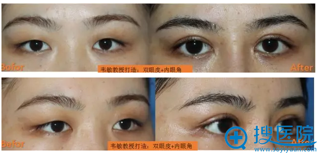 上海九院韦敏教授双眼皮+内眼角案例对比图