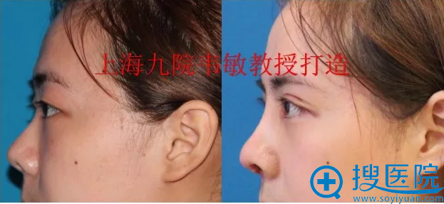 上海九院韦敏教授隆鼻+双眼皮案例侧面对比图