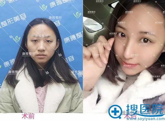 <!--<i data=20240710 data-id=12505></i>--><!--<i data=20240710 data-id=16805></i>-->蒜头鼻矫正案例