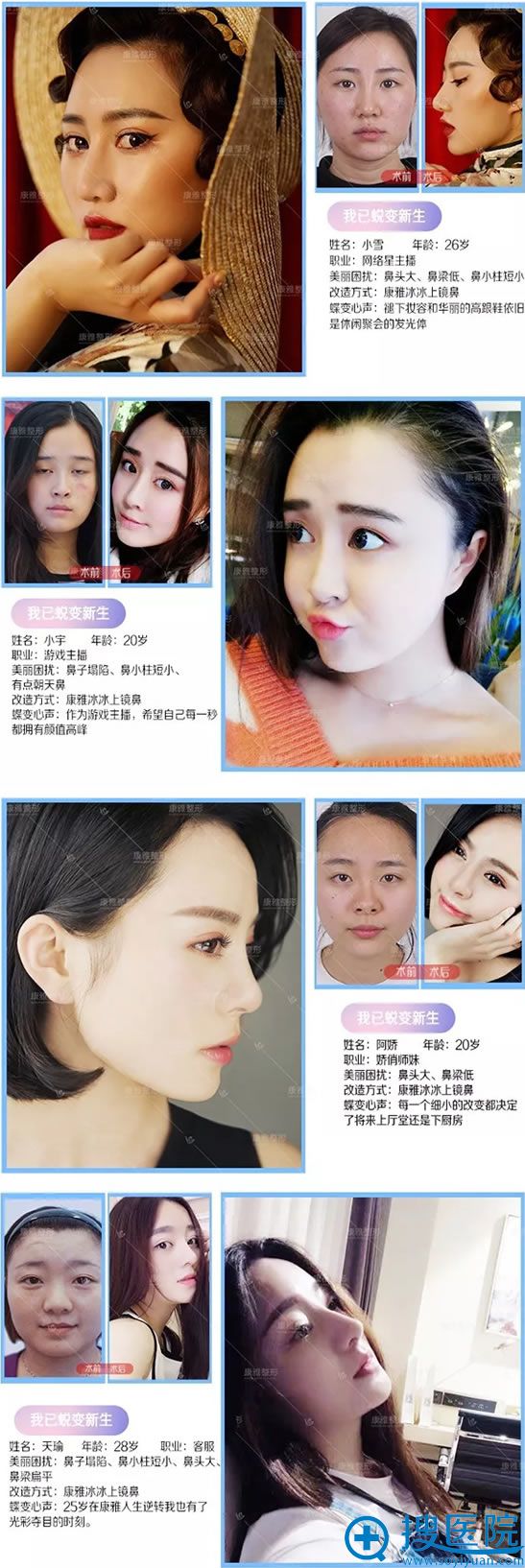 整鼻医生<!--<i data=20240710 data-id=16805></i>-->的仿生隆鼻案例