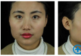 用我的颧骨下颌角案例来告诉你上海首尔丽格朴兴植整脸型怎么样