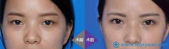 切开双眼皮术后3个月恢复效果图