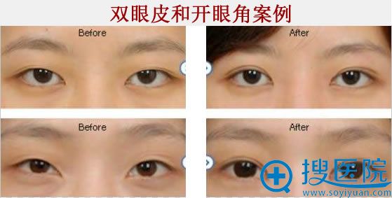 韩式双眼皮和开眼角前后对比图
