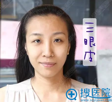 做手术前的三眼皮照片 做手术前的三眼皮照片