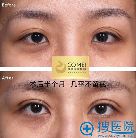 三眼皮做双眼皮手术半个月效果 三眼皮做双眼皮手术半个月效果