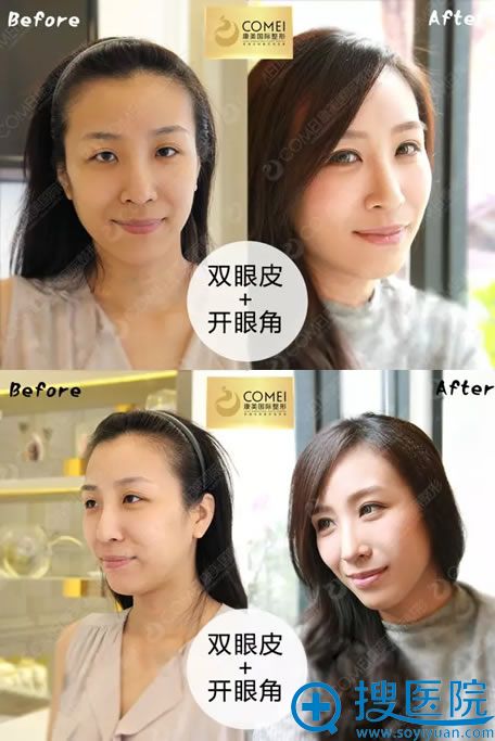 <!--<i data=20240710 data-id=15772></i>-->刘小剑双眼皮案例对比图 <!--<i data=20240710 data-id=15772></i>-->刘小剑双眼皮案例对比图